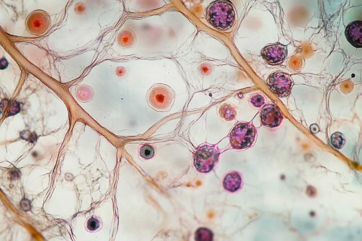 Recurrent Candidiasis: Why It Happens and How to Prevent It
