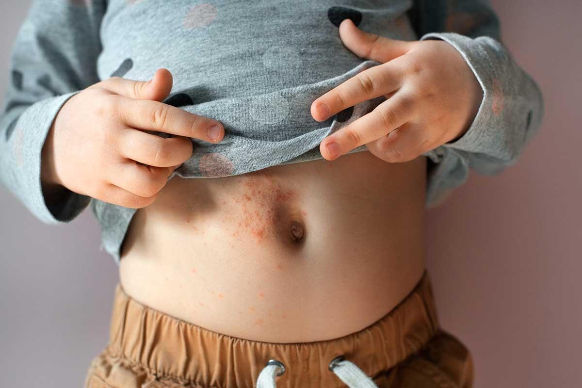 Understanding Scabies: Causes, Symptoms, and Effective Treatments