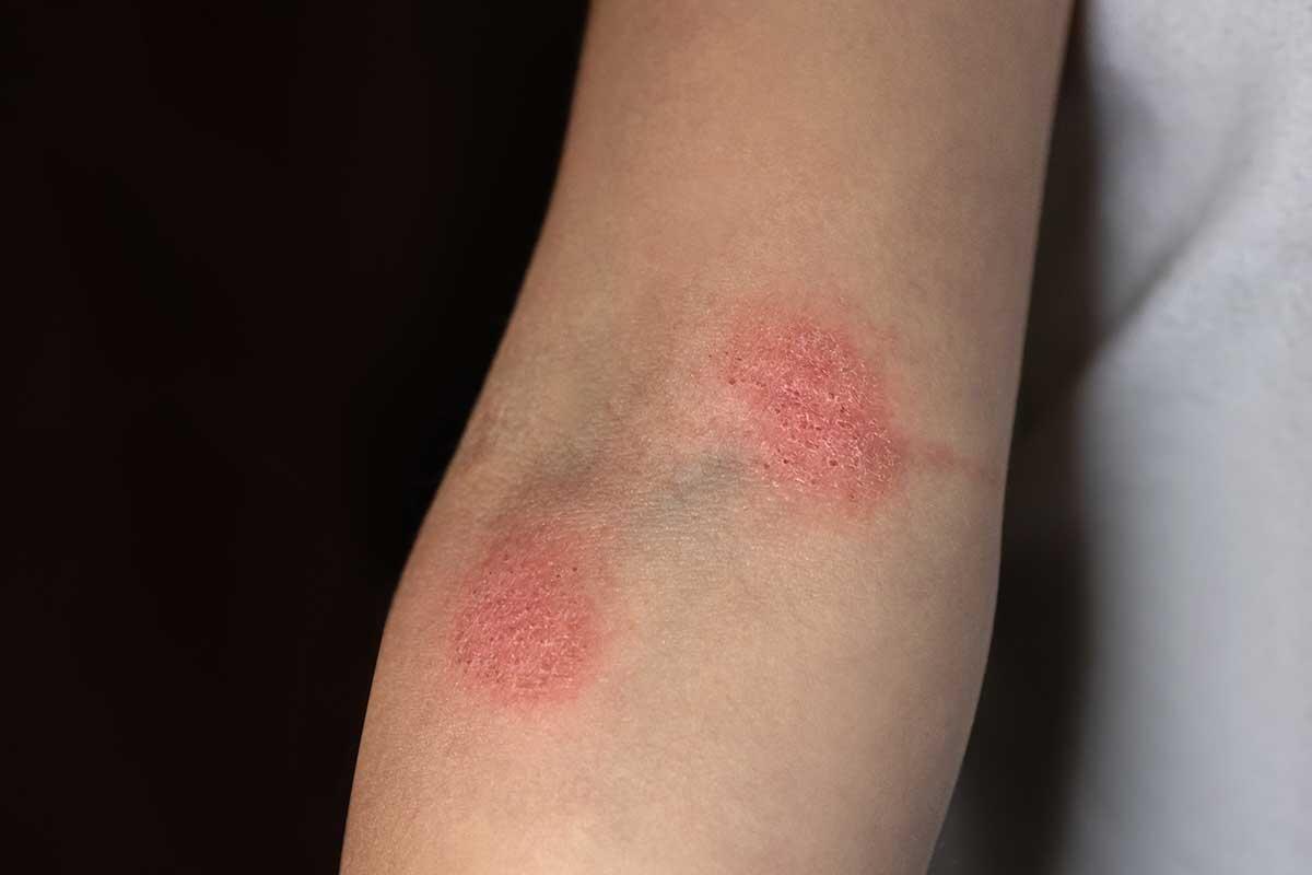 Fungal Infections: Causes, Types, Symptoms, and Treatments
