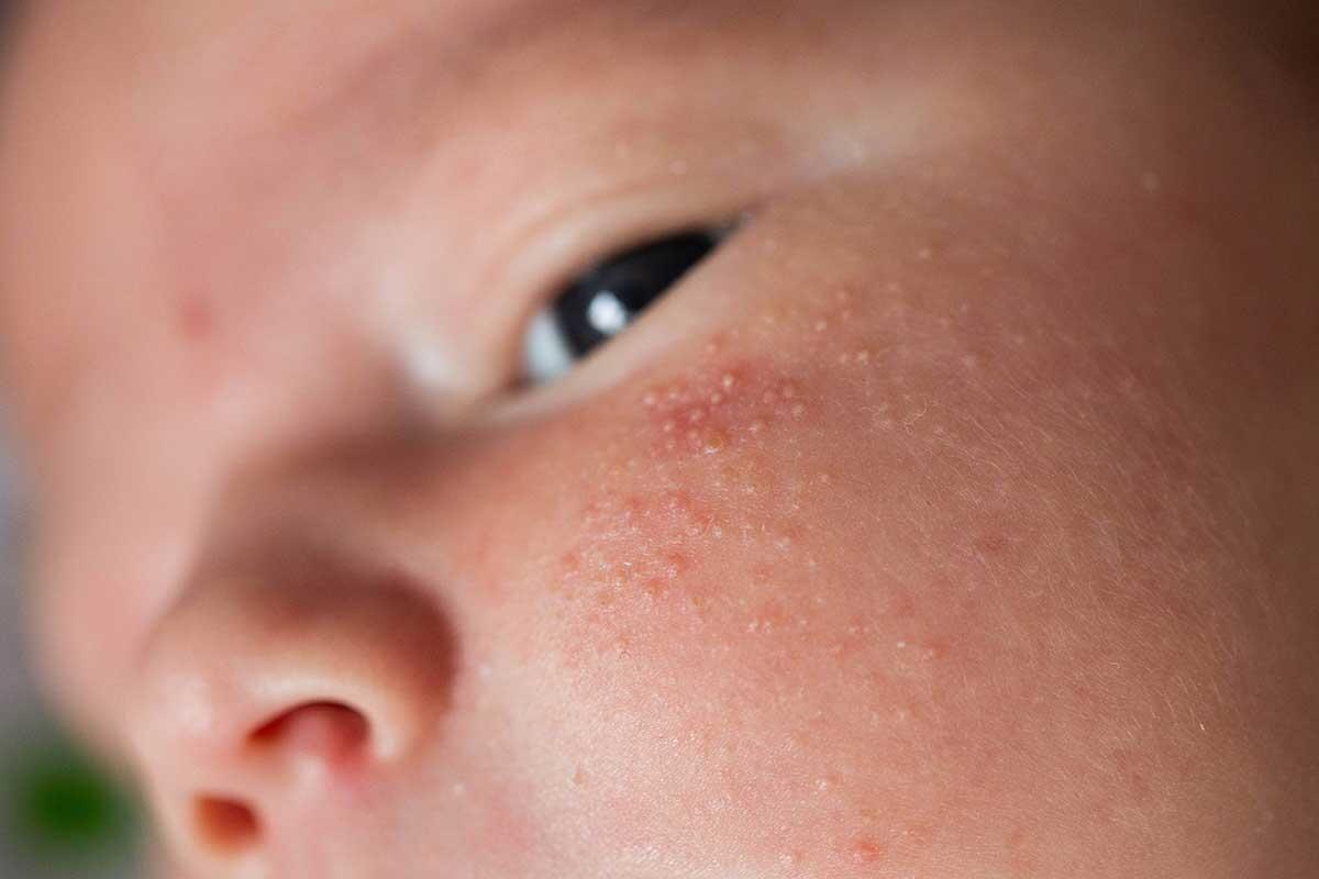 Heat Rash: Causes, Symptoms, and Effective Treatments