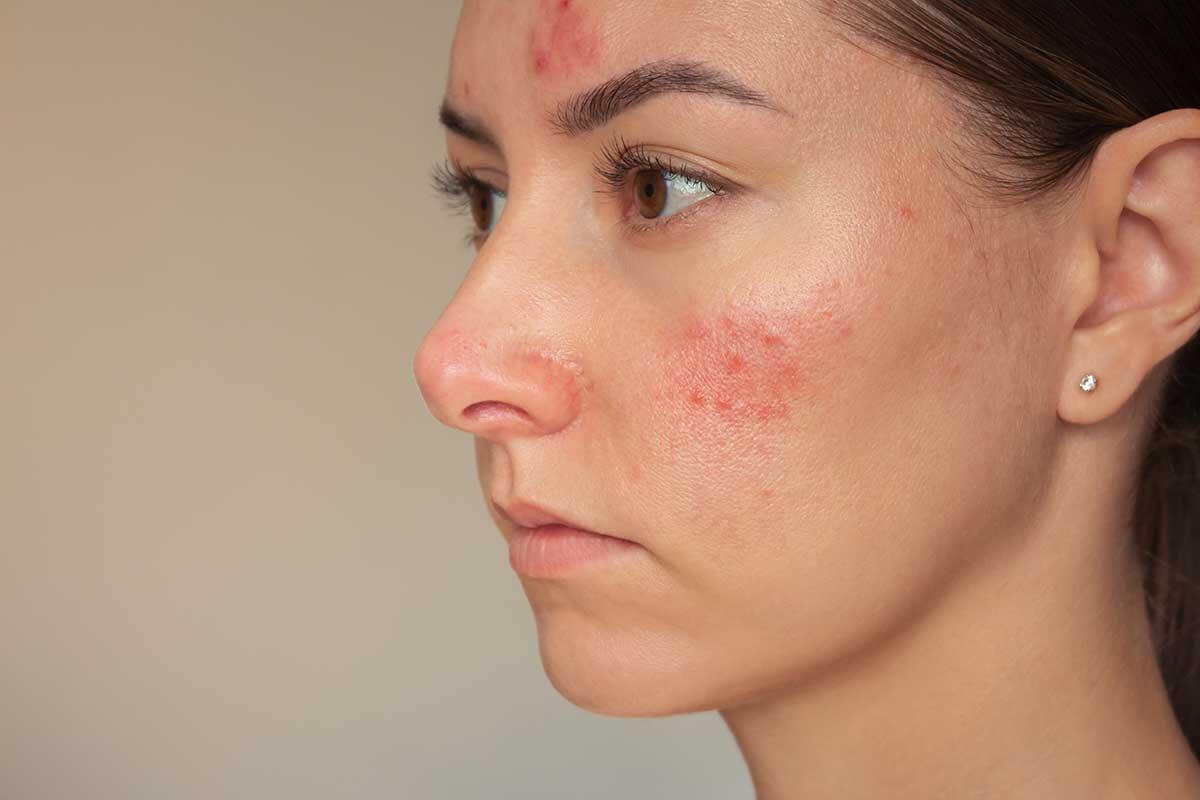 Understanding Rosacea: Causes, Symptoms, and Effective Treatments