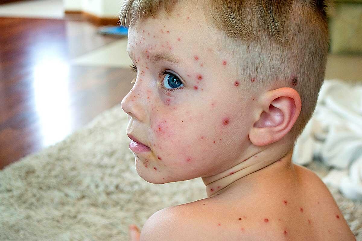 Chickenpox, Rubella, and Measles: Symptoms, Prevention, and Treatments