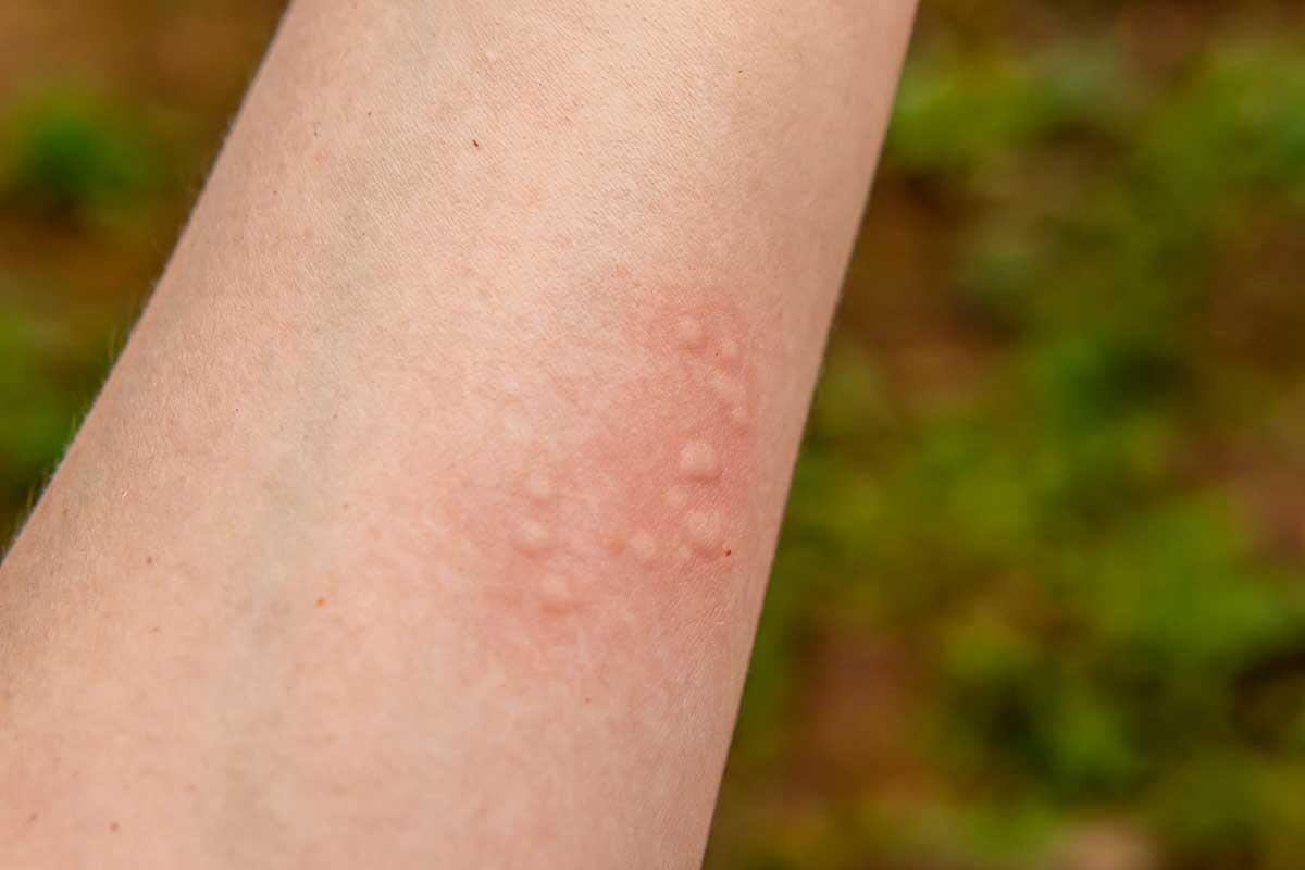 Everything About Hives (Urticaria): Symptoms, Causes, and Treatments