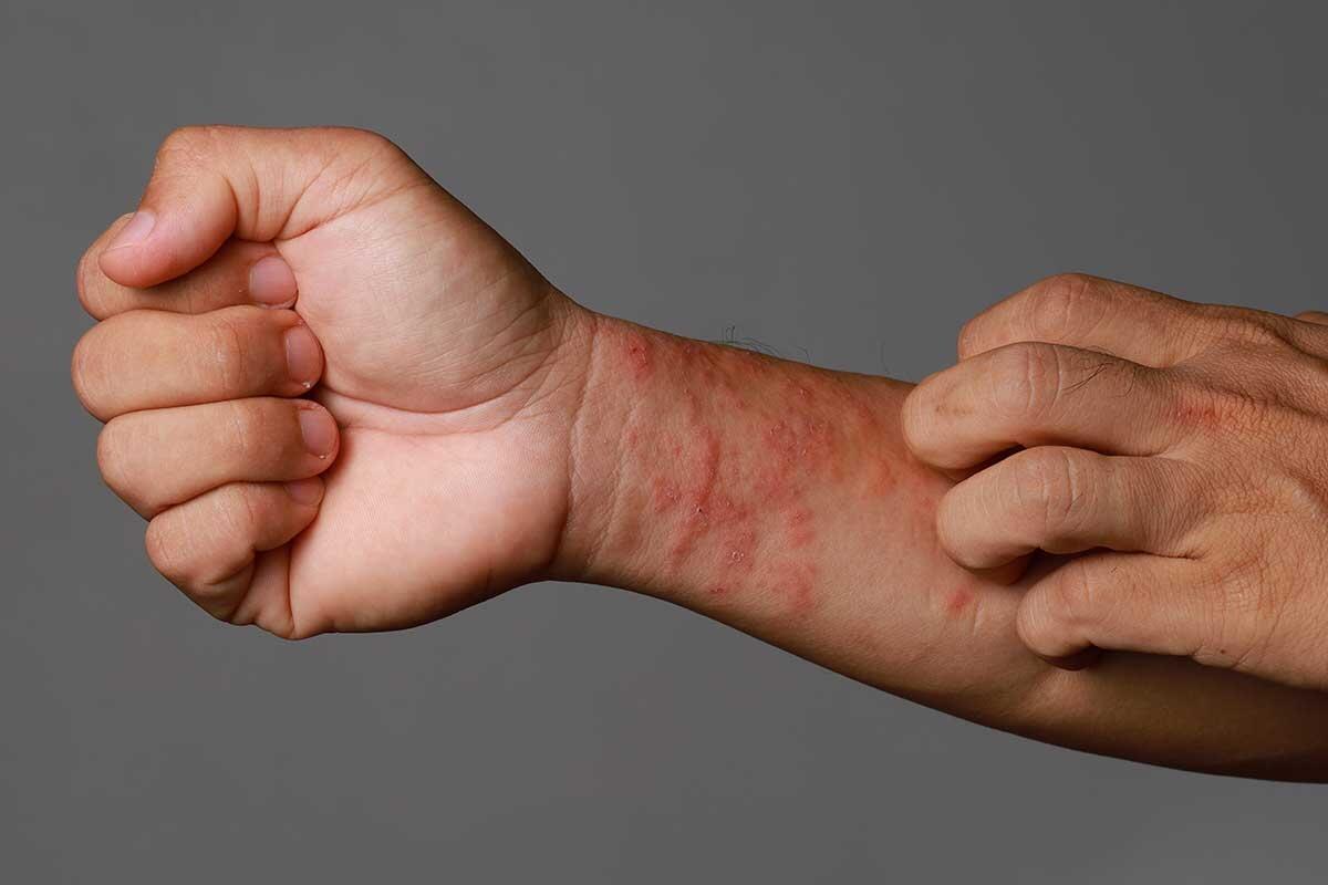 Eczema: Symptoms, Causes, and Effective Treatments