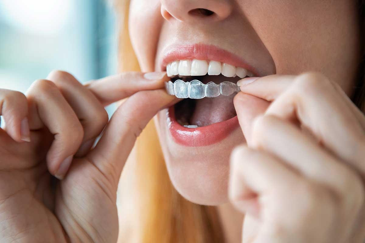 Invisalign Treatment